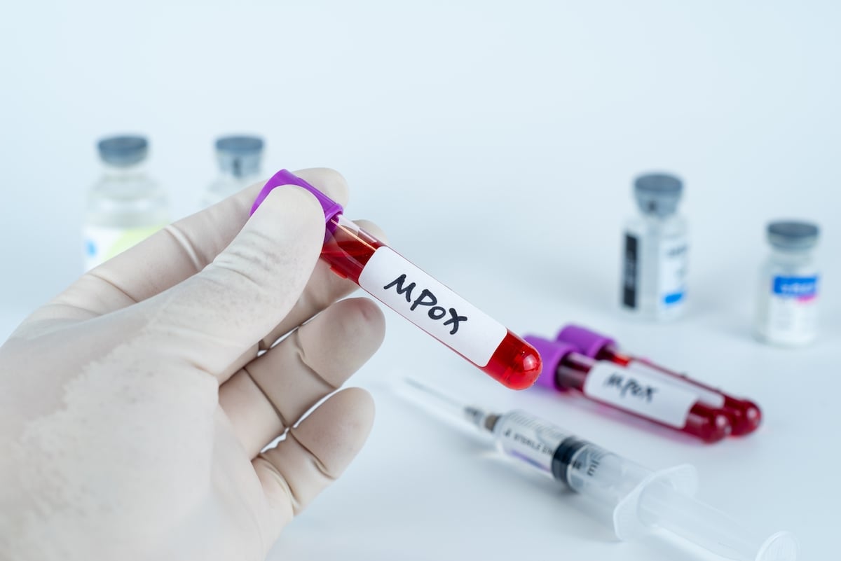 113 fioles de Mpox en valise: l'élite déconnectée frappe encore